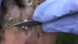 ازاله البراغيث الثاقبه من قدم - مترجم ليس لذوي القلوب الضعيفه Jigger Removal (jigger disease)