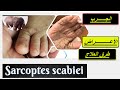 Scabies الجرب اسبابه العلاج الموضعي والفموي واثناء الحمل كيفية الوقاية 