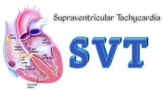 Supraventricular Tachycardia || AVNRT || AVRT