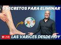5 secretos para eliminar las várices desde hoy