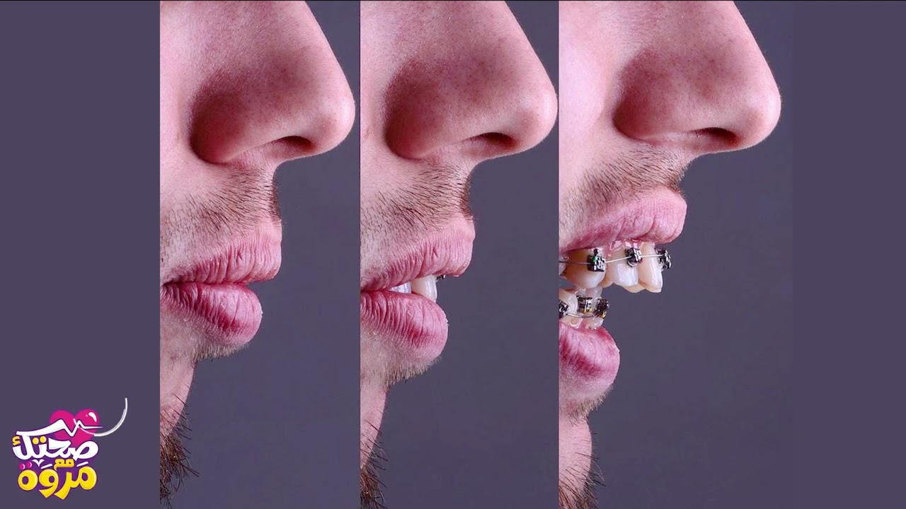 لو فات وقت التقويم اية العمل هل لازم نعمل جراحة