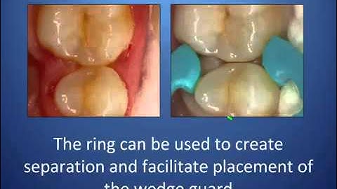Class II Restoration Webinar with Nick Conte, DDS | Dentsply Sirona