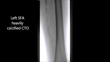 TruePath Left SFA CTO #2