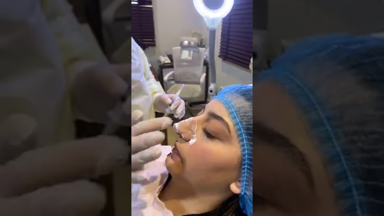 تجميل الأنف بدون جراحة