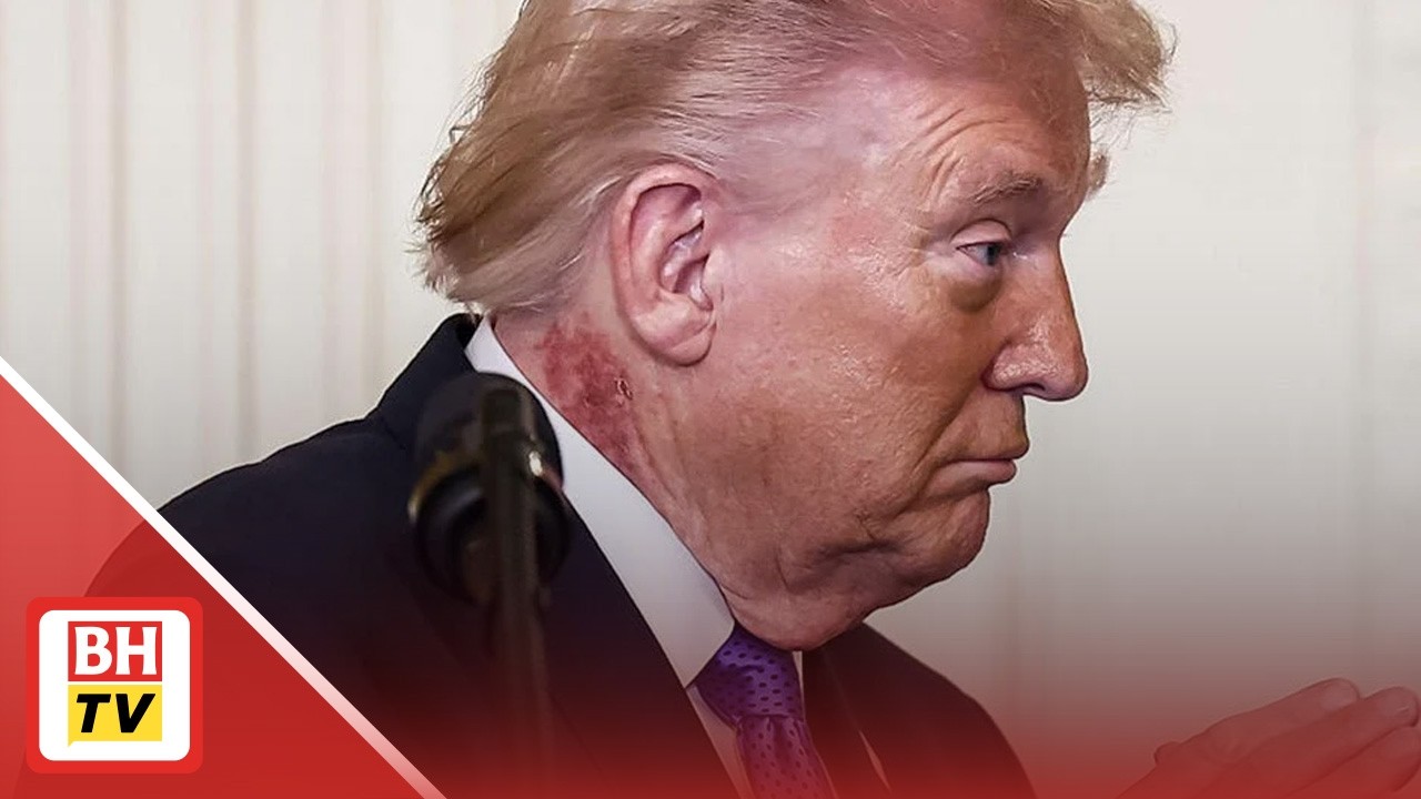 Ruam merah ketara kelihatan di leher Trump