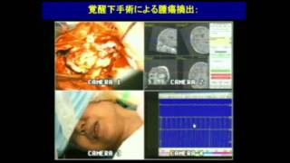 脳腫瘍（成人）の診断・治療と今後について 成田 善孝