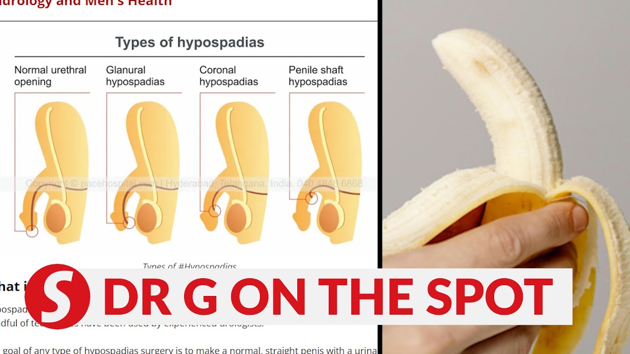EP226: Can hypospadias affect one’s reproductive life? | PUTTING DR G ON THE SPOT
