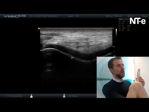 Video: Artrose Van De Knie-röntgenfoto