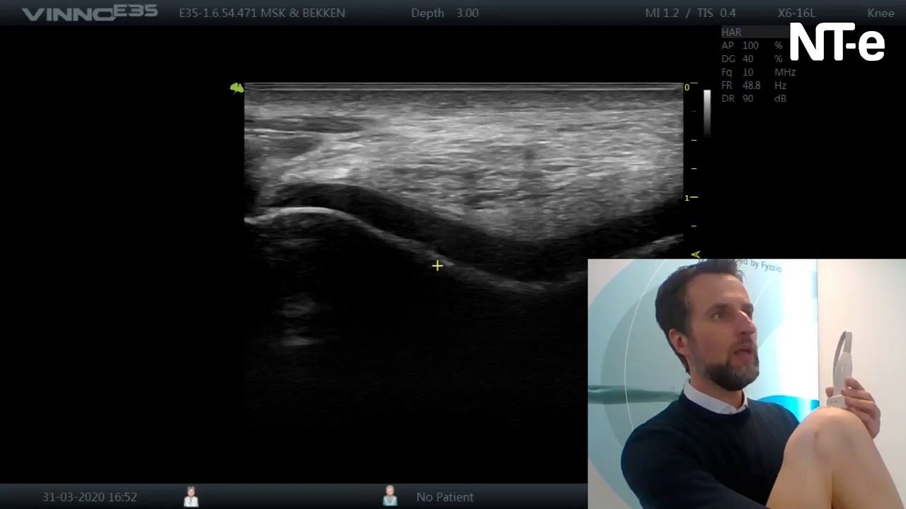 Echografie van het kraakbeen van de knie