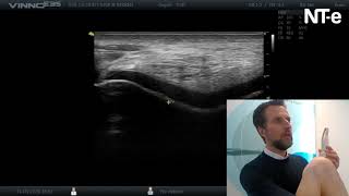 Echografie Van Het Kraakbeen Van De Knie