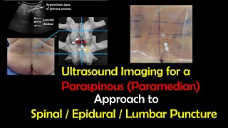 Ultrasound Imaging for the Paraspinous Approach to Spinal / Epidural Anesthesia & LPs