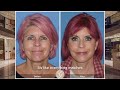 62 year young facial rejuvenation  dr kevin sadati