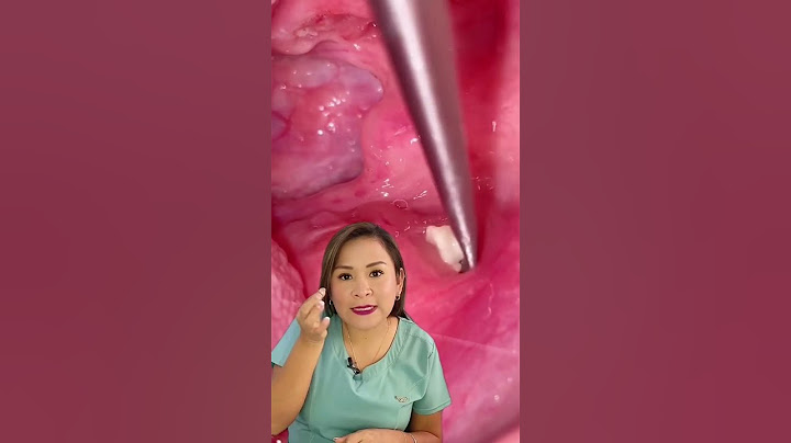 Y tú, ¿las tienes?     #tonsilolitos #garganta #dental #Sonrisasegura