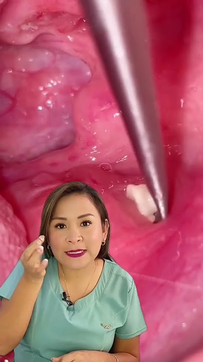 Y tú, ¿las tienes?     #tonsilolitos #garganta #dental #Sonrisasegura