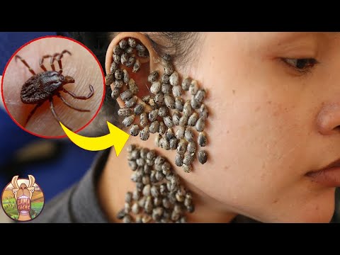 Vidéo: Est-ce qu'un insecte a rampé dans mon nez ?