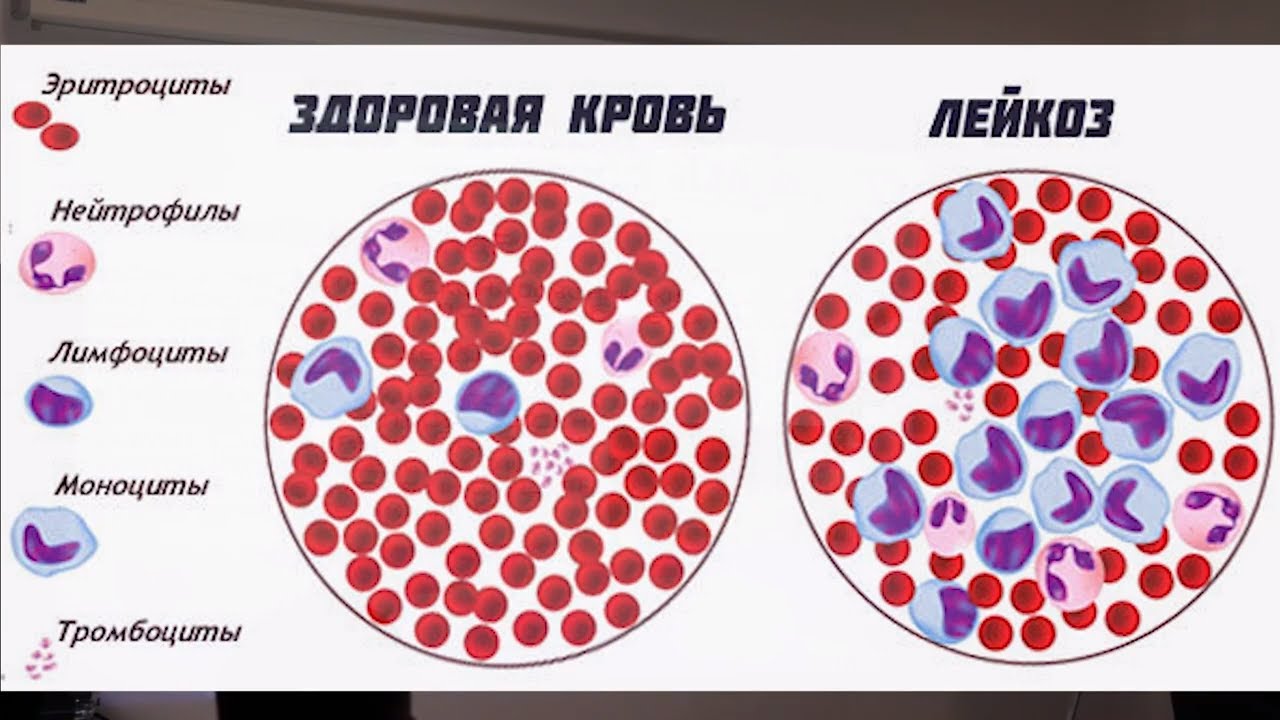 Трансфер Фактор при онкологии. Рак не приговор.Лисовая Татьяна Семейный ...
