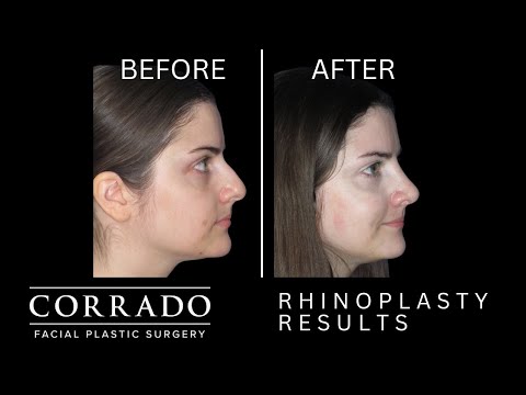 Video thumbnail: Rhinoplasty Surgery Testimonial: 3 Weeks Post Op · Dr. Anthony Corrado