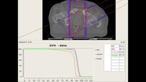 Real time dose calculation: live updating DVH