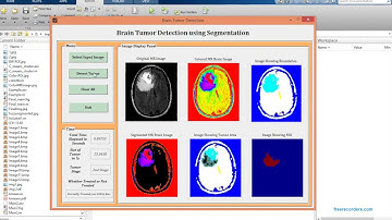 MATLAB code of Brain Tumor Detection using Segmentation