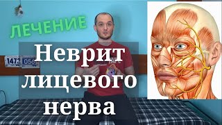 Неврит лицевого нерва. Лечение. Кинезиология и Остеопатия