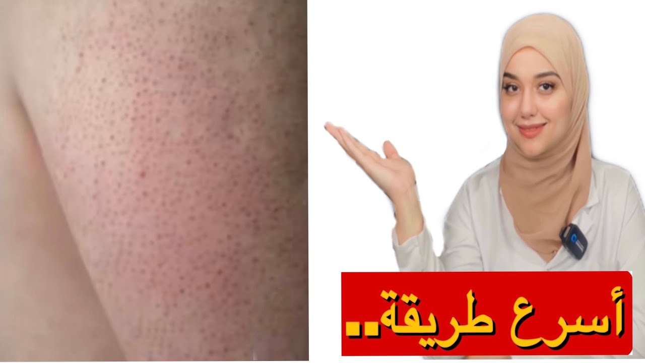 مكون سحرى للحصول على جلد ناعم كالحرير/التخلص نهائيا من جلد الوزةواحتباس الشعر تحت الجلد و تحبب الجلد