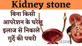 गुर्दे की पथरी का बिना आपरेशन इलाज |  kidney stone | किडनी की पथरी निकालने का आसान घरेलू उपाय