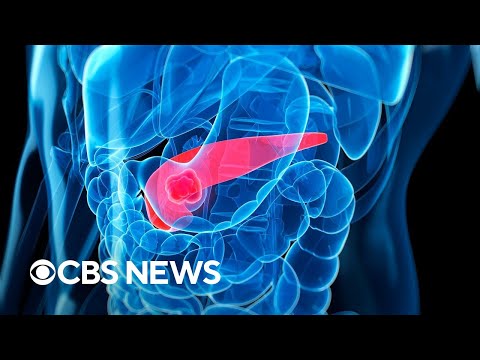 Why pancreatic cancer is hard to diagnose and treat