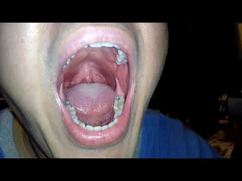 Growing White Lumps Pimples Inside Mouth On Tongue and Around Gums