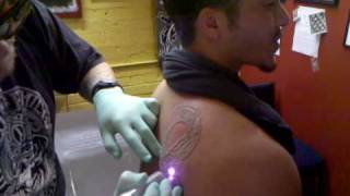 Nicks laser tattoo removal at Jinx Proof