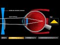 Troubles de la vision myopie et hypermtropie