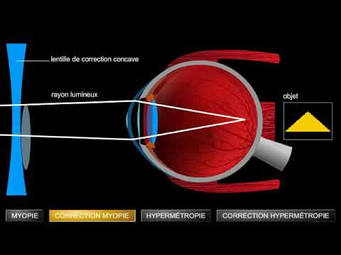 Vidéo: Où se forme l'image dans un œil hypermétrope ?