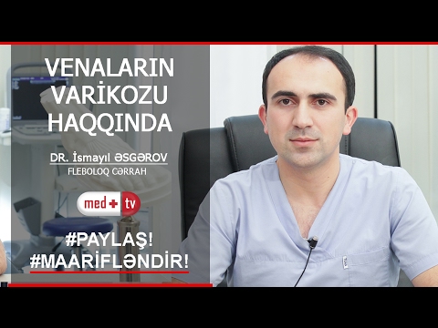 Video: Hörümçək damarları varikozdur?