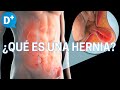 Hernias: ¿Qué es una hernia y por qué se produce?