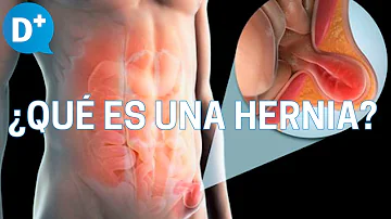 ¿Cuál es la hernia más frecuente en el varón?