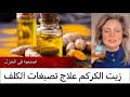 اصنعي زيت الكركم في المنزل علاج فعال تصبغات الوجه والكلف د لبينة الرحية 