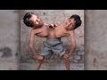 Conjoined Twins: Brothers Joined At The Hip Learn To Live In Harmony