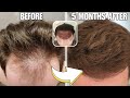 The secret to early hair transplant growth dr bisanga