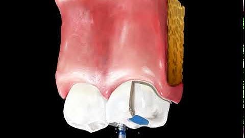 Clearwater Periodontist Shares EZ Dent Video: Crowns