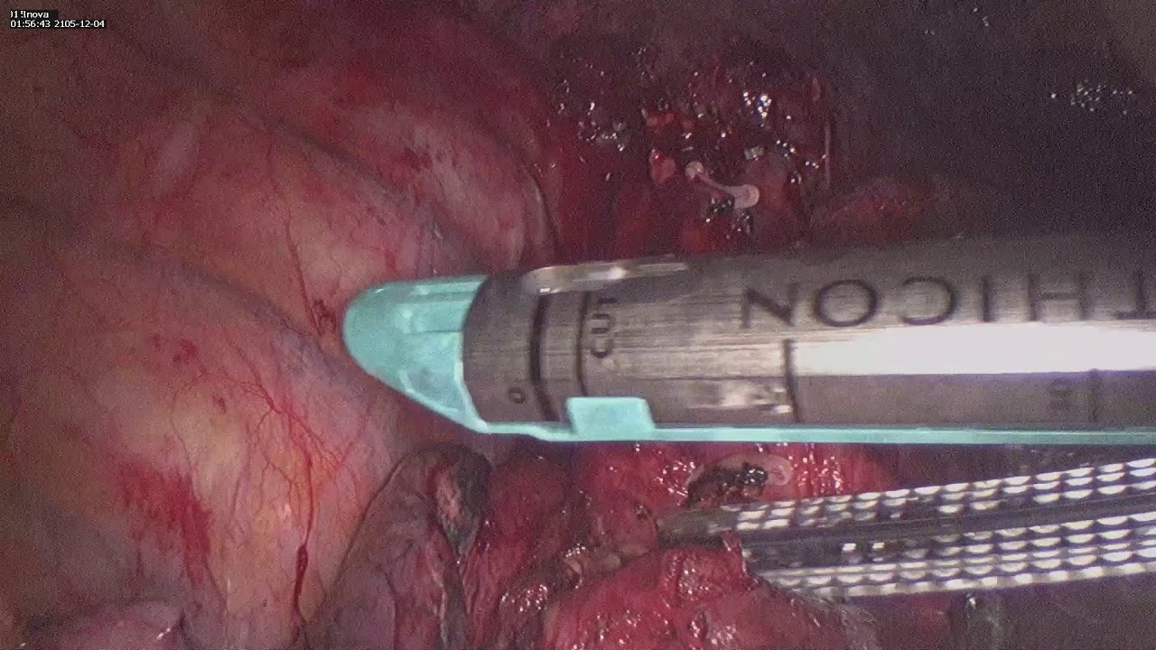 S2/S6 RIGHT VATS Segmentectomy for synchronous adenocarcinoma