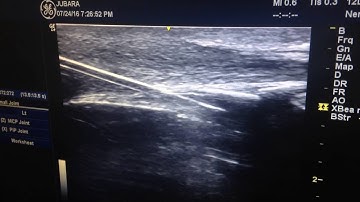 Ultrasound guided caudal epidural