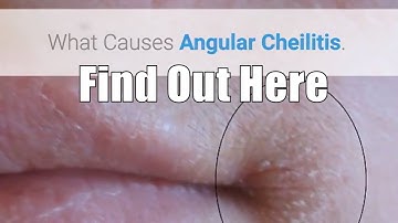What Causes Angular Cheilitis Will Surprise You!