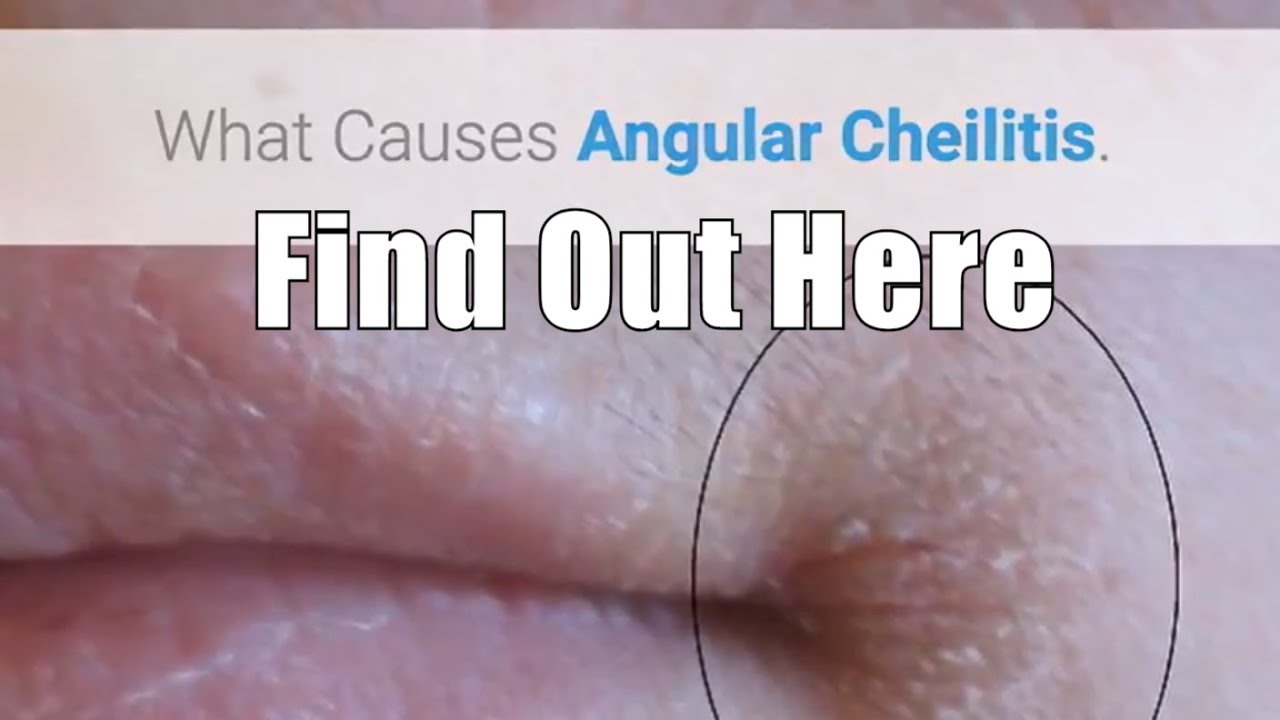 pics Amber Listerine For Angular Cheilitis cyberspaceandtime com
