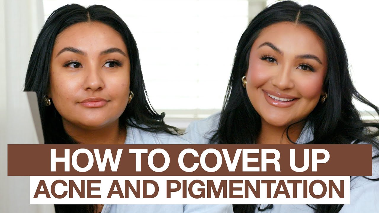 This is how you cover up acne and pigmentation with makeup