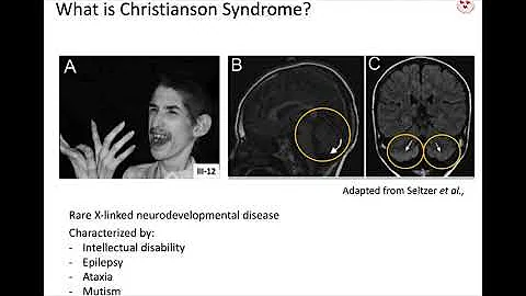 The NHE6 receptor and pain in Christianson Syndrome