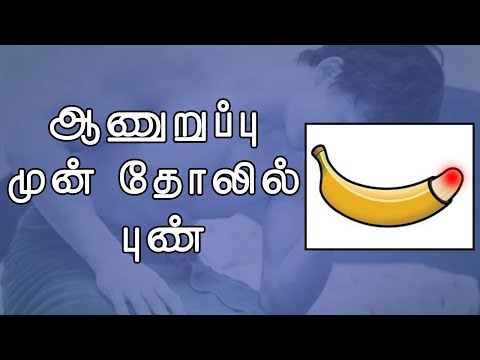 ஆணுறுப்பு முன் தோலில் புண் | பால்வினை நோய்கள் பற்றிய விழிப்புணர்வு | சர்க்கரை வியாதி-Skin Disorders