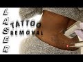 MY LASER TATTOO REMOVAL RESULTS! | Tattoo Removal on Dark Skin