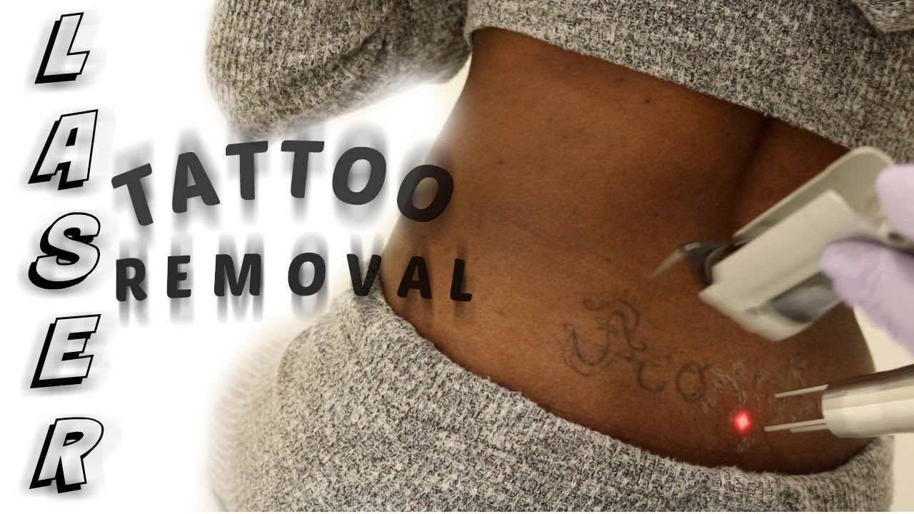 Tattoo Removal on Black  Asian Skin  Lorena Oberg