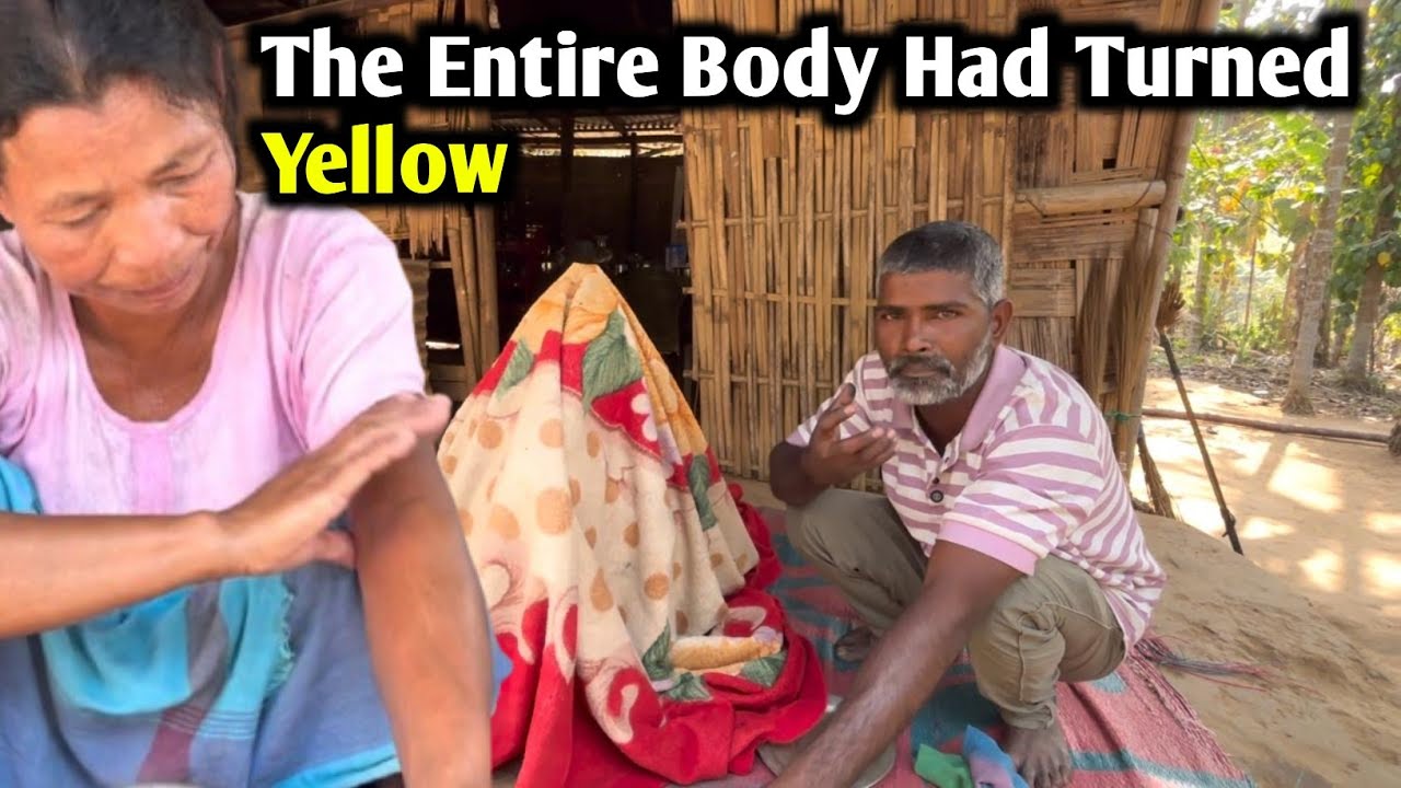 The Entire Body Had Turned Yellow 