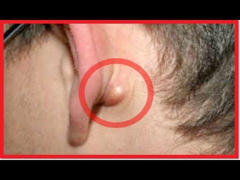 que significa tener una bolita detras de la oreja