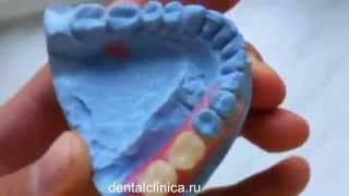 Лечение зубов красивая улыбка виниры коронки протезирование имплантация приятные цены(, 2014-03-25T19:49:55.000Z)